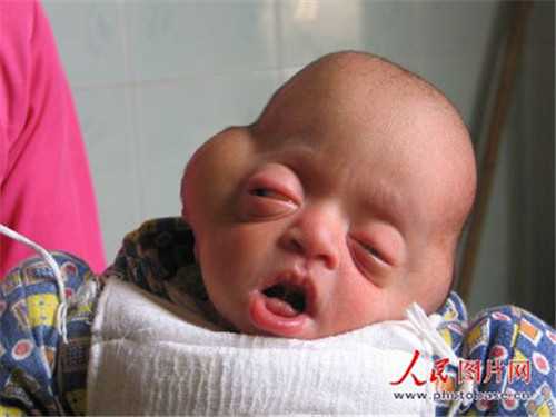 四川美女供卵_泰国试管婴儿缺点 精索静脉曲张在广州做手术费用高吗?
